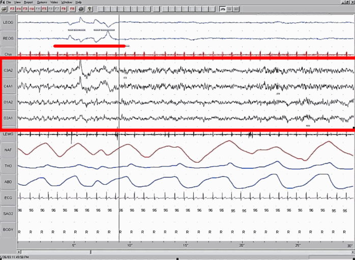 Sleep EEG REM.png